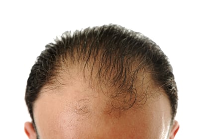 Hair loss-1